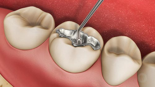 Restauração de amálgama em dente molar