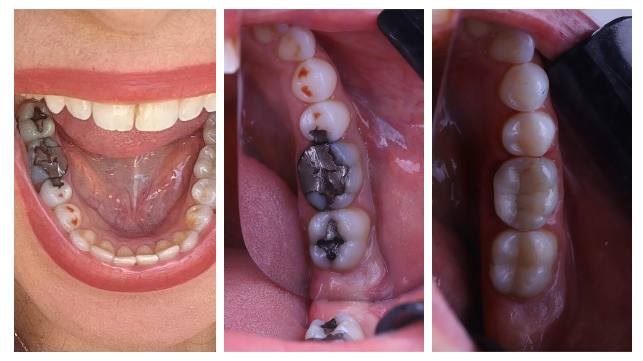 Casos reais de restaurações de amálgama em pacientes