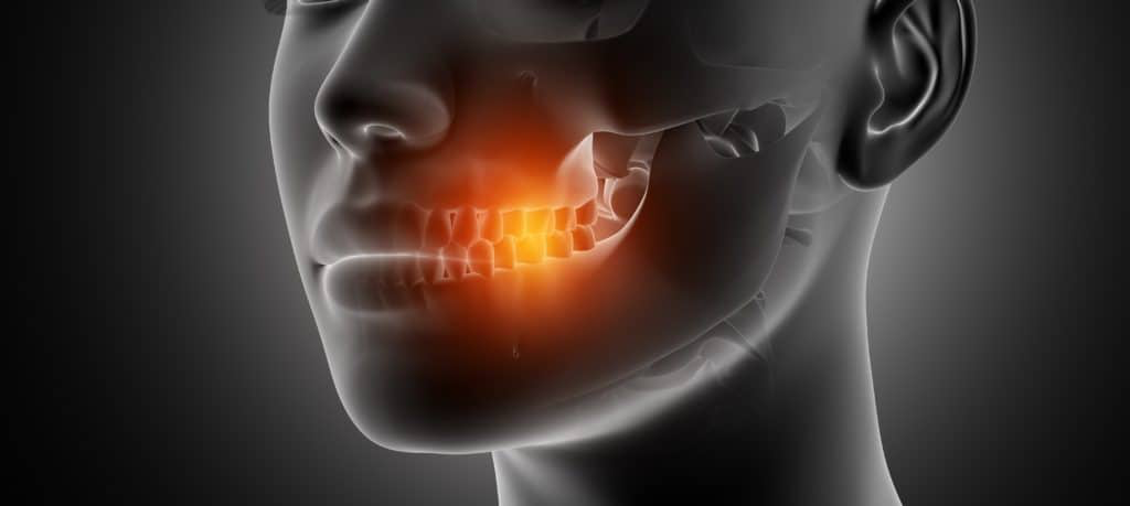 Ilustração 3D de cavitação no osso maxilar