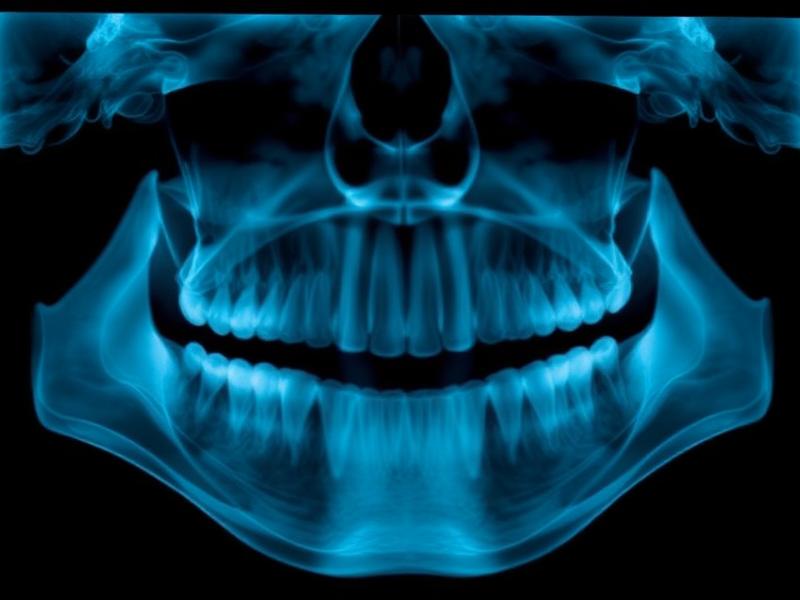 Tratamento de cavitações osteonecróticas em Blumenau